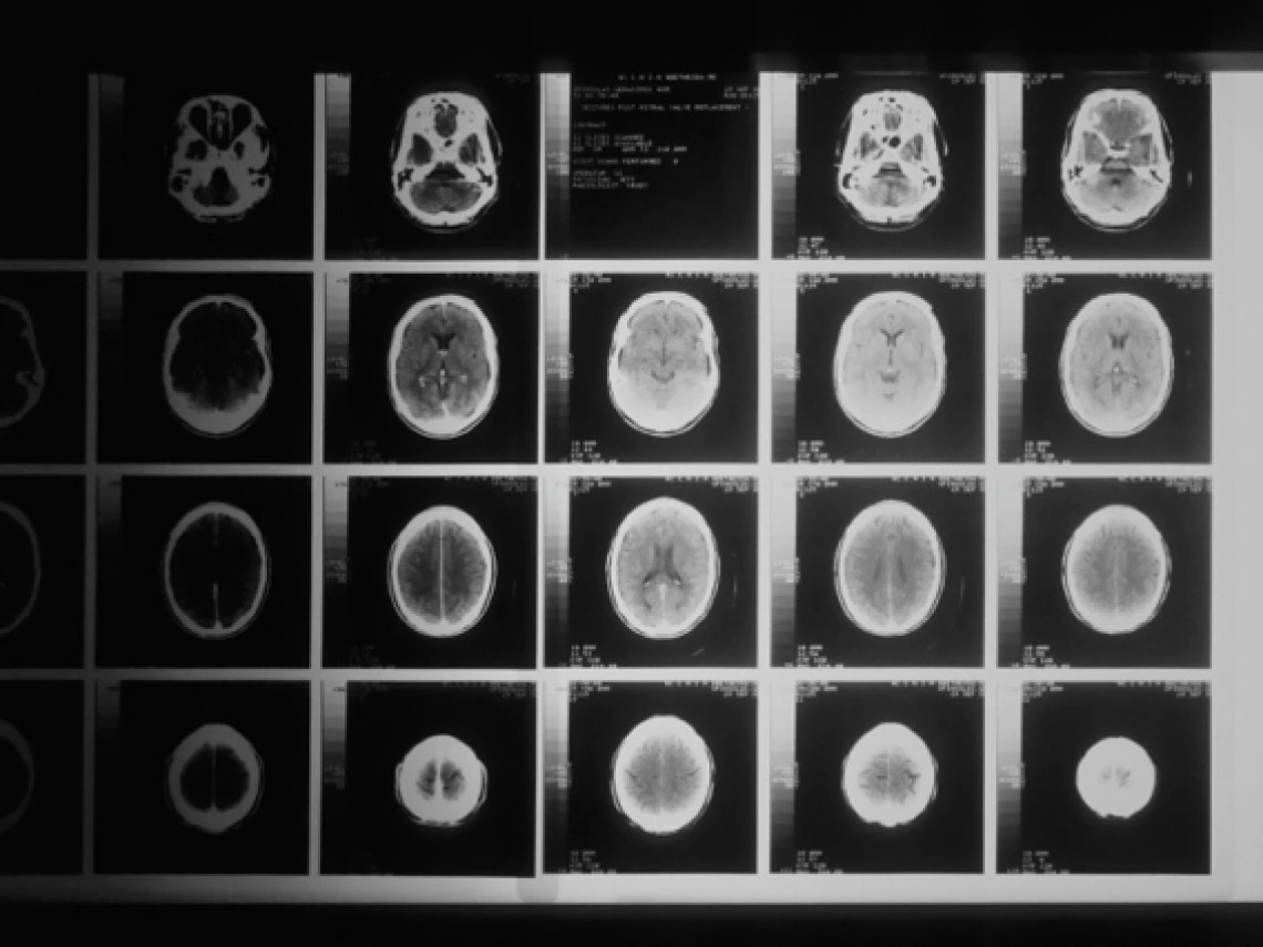 Series of brain scan images